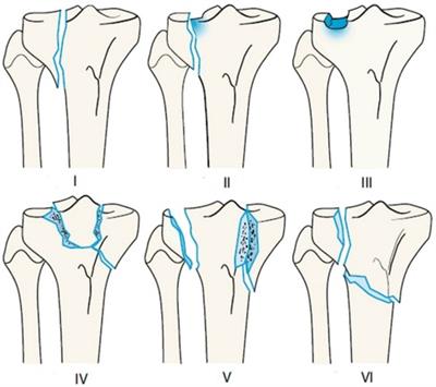 Current concepts review. Management of proximal tibial fractures